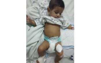 Antenatal Hydronephrosis